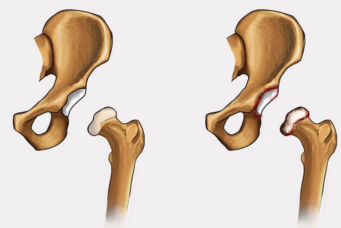 degenerativní změny a bolesti kyčelního kloubu