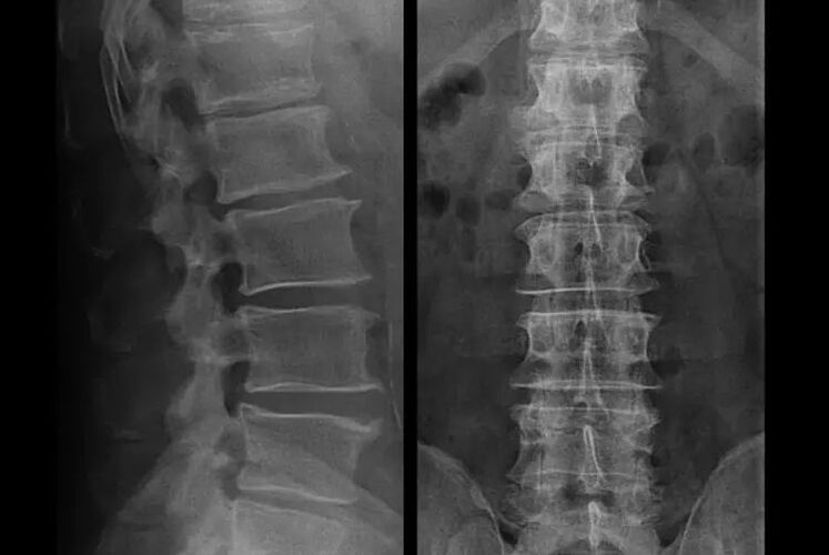 osteochondróza na rentgenu