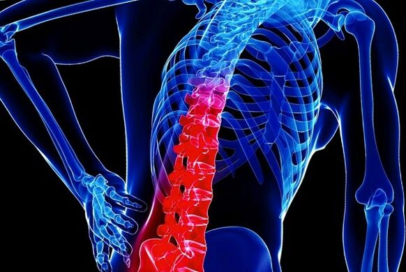 Důvody rozvoje hrudní osteochondózy