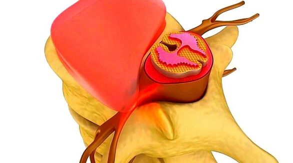 osteochondrosis hrudní páteře podstata onemocnění