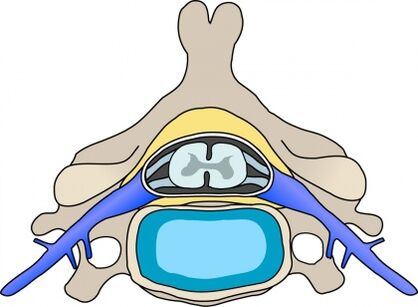 Protabius v obratle s cervikální osteochondózou